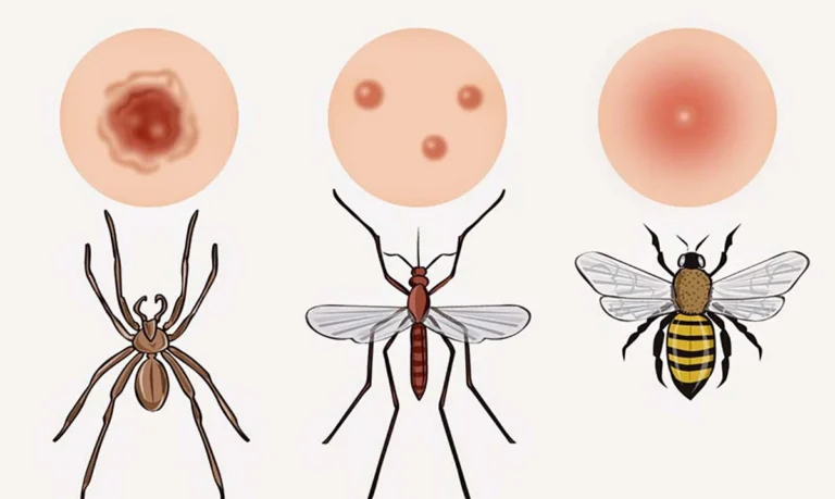 Todo lo que debes saber sobre las picaduras de insectos: Una guía completa para un reconocimiento fácil