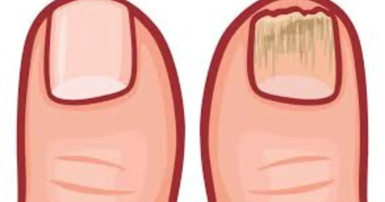 Uñas que Hablan: Guía Completa sobre Enfermedades Ungueales y Salud