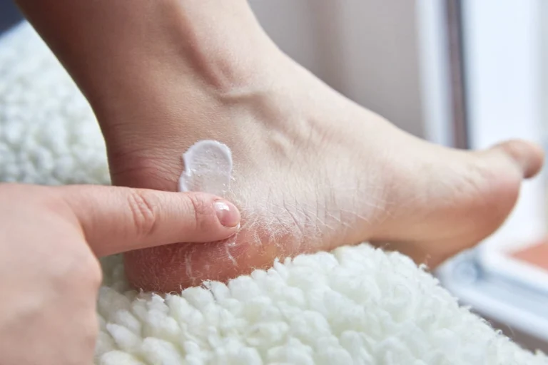 ¡Dile Adiós a los Talones Agrietados! 5 Remedios Naturales que Realmente Funcionan