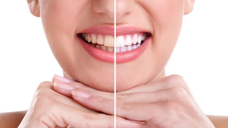 ¡Desbloquea una Sonrisa Brillante en Casa con Arroz, Jengibre y Limón!