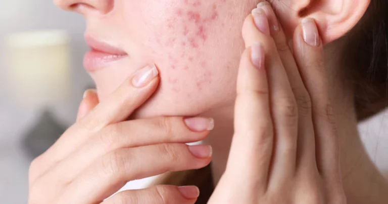 Alimentación y acné: cómo la dieta influye en la salud de tu piel