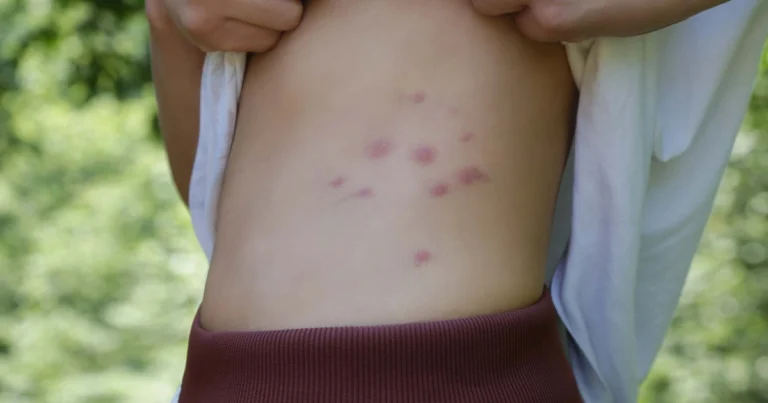 Guía para identificar las picaduras de insectos más comunes