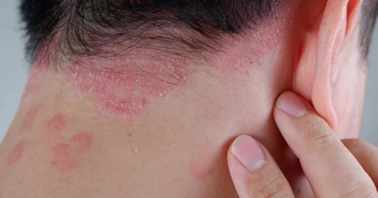 Aceite de aloe vera para la piel: un remedio natural contra la psoriasis, el eccema y la dermatitis