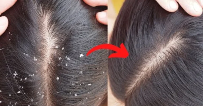 Cómo desintoxicar el cuero cabelludo para estimular el crecimiento del cabello