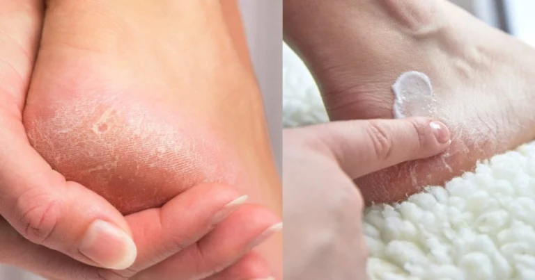 Mascarilla casera para pies secos y agrietados: recupera suavidad y juventud