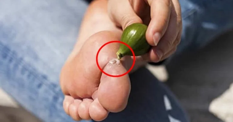 El látex de higo para eliminar las verrugas de forma natural