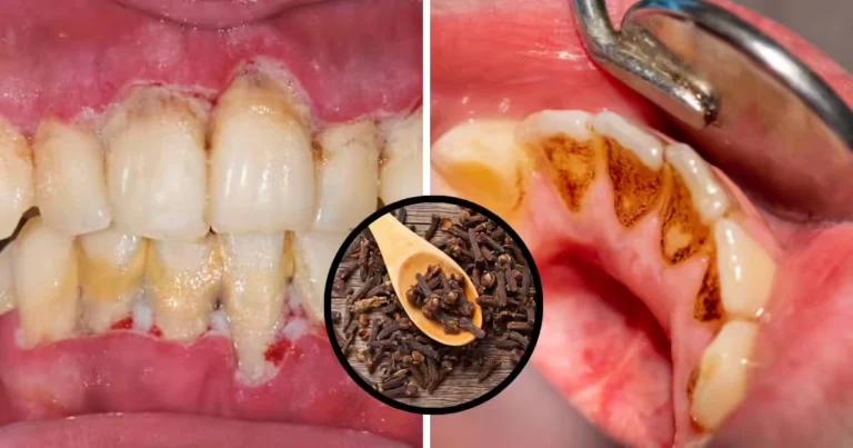 Clavo de olor: el secreto natural para una sonrisa limpia y saludable