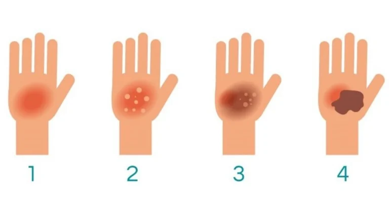 Grados de quemaduras en la piel: guía completa para identificarlas y actuar de forma segura