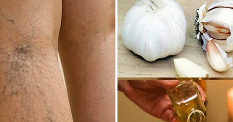 Ajo y aceite de oliva: remedio natural para mejorar las varices