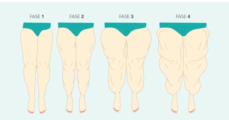 Diferencia entre grasa normal y lipedema: cómo identificarlas y cuándo consultar