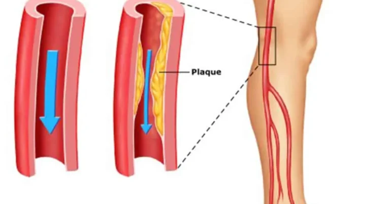 Enfermedad arterial periférica: causas, síntomas y cómo mejorar el flujo sanguíneo