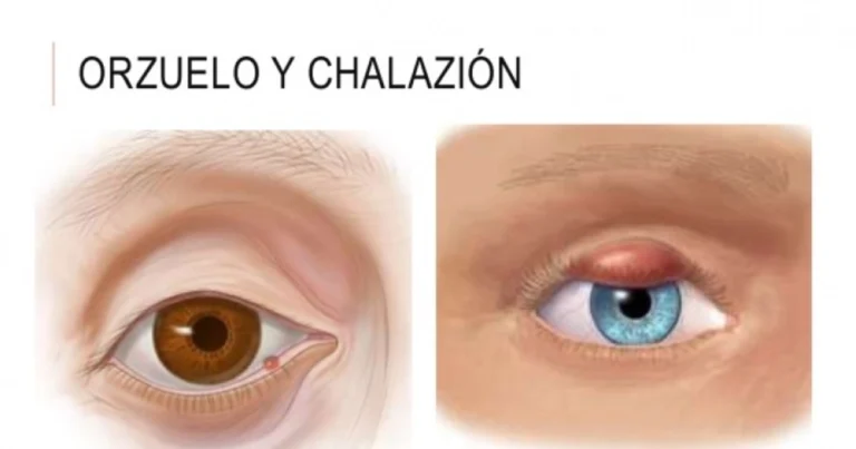 Orzuelo vs chalazión: diferencias clave y cuándo consultar al médico
