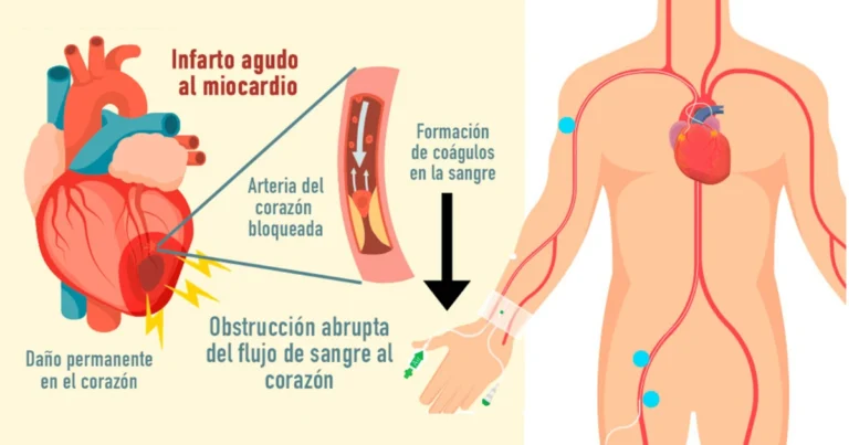 Diferencia entre infarto y paro cardíaco: síntomas, causas y qué hacer en una emergencia